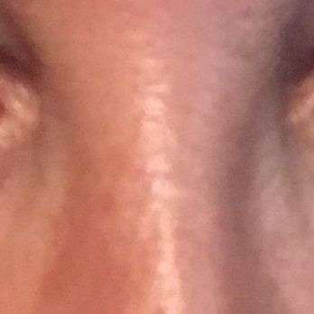 Ronald J Edelson, MD - Before: lower lids - Cosmetic Surgeons Near Me - San Diego, California Ronald J Edelson, MD - Before: lower lids - Cosmetic Surgeons Near Me - San Diego, California