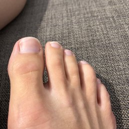 This is the beginning stages of toenail fungus. Hopefully I will be able to remedy it prior to it getting unmanageable. This is the beginning stages of toenail fungus. Hopefully I will be able to remedy it prior to it getting unmanageable.