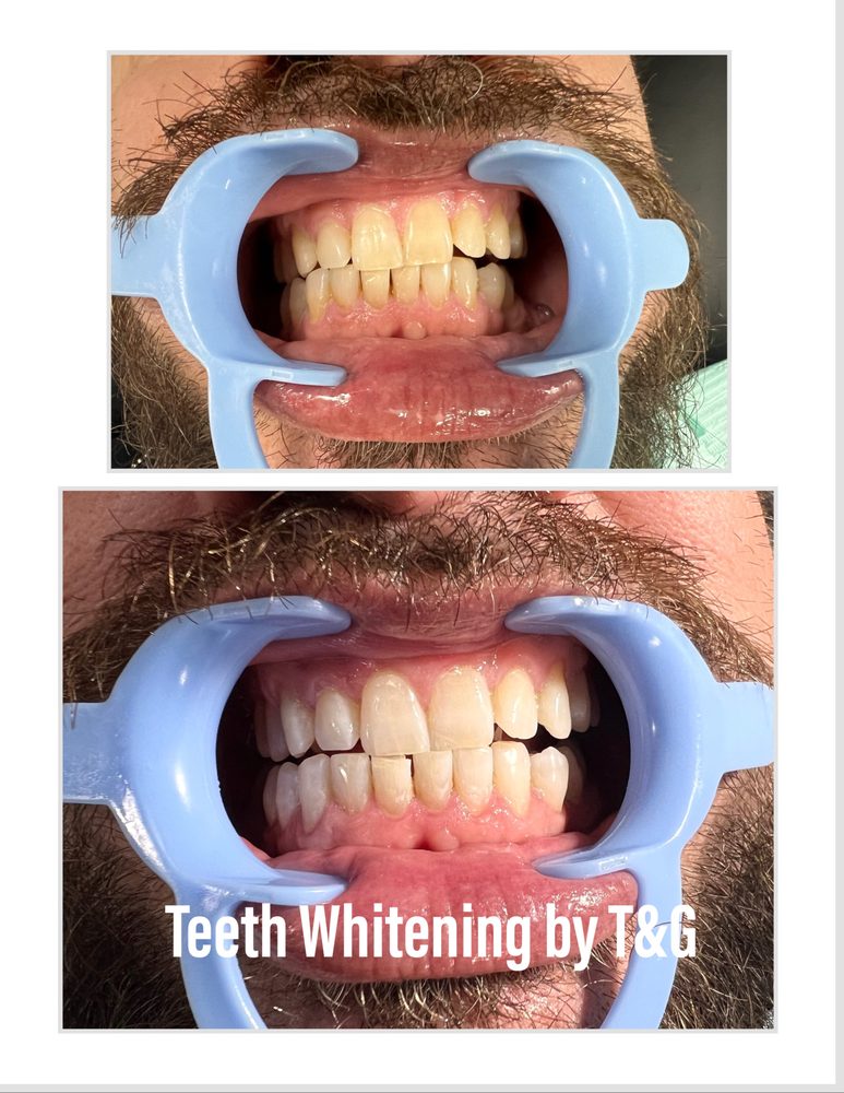 TEETH WHITENING BY T&G Updated September 2024 49 Photos & 57