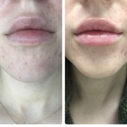 Left - immediately before filler. Right - immediately after, before the swelling kicked in. We used 1 syringe of Restylane-l