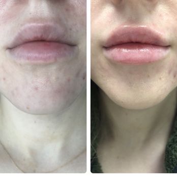 Allure Esthetic - Left - immediately before filler. Right - immediately after, before the swelling kicked in. We used 1 syringe of Restylane-l - Cosmetic Surgeons Near Me - Seattle, Washington