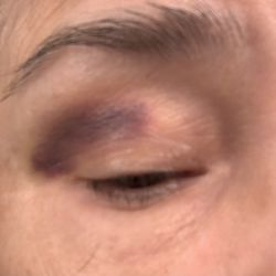 Peach Skin & Laser - Eyelid bruise.