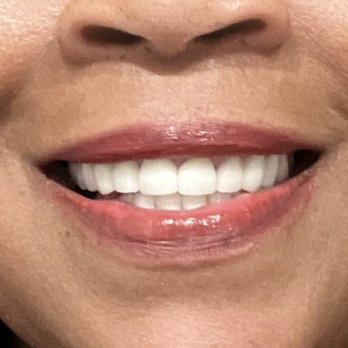 1385 Dental Studio - Natural Smile Makeover 2023 Dr. Hala Mustafa 1385 Dental Studio in Aubrey, Texas. - General Dentistry Near Me - Aubrey, Texas 1385 Dental Studio - Natural Smile Makeover 2023 Dr. Hala Mustafa 1385 Dental Studio in Aubrey, Texas. - General Dentistry Near Me - Aubrey, Texas