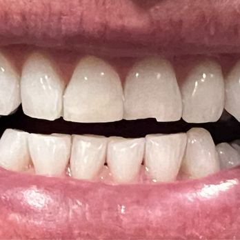 Hornbrook Center For Dentistry - Before - Cosmetic Dentists Near Me - La Mesa, California Hornbrook Center For Dentistry - Before - Cosmetic Dentists Near Me - La Mesa, California