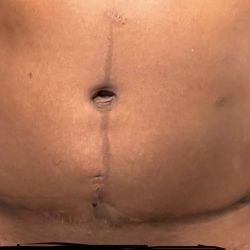 Chicago Aesthetic Surgery Institute - This how he do his work this his tummy tuck