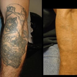 Project Erase Tattoo Removal