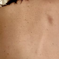 On Point Massage - Bruises after a deep tissue massage
