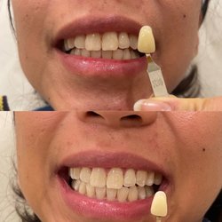 ChillRx Cryotherapy Montclair - $125 teeth whitening not worth it for me