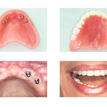 Stephen A Genus, DMD - * Implant Supported Dentures: This type of implant denture is used in place of a full denture to replace an entire bridge of missing teeth. - General Dentistry Near Me - Sacramento, California Stephen A Genus, DMD - * Implant Supported Dentures: This type of implant denture is used in place of a full denture to replace an entire bridge of missing teeth. - General Dentistry Near Me - Sacramento, California