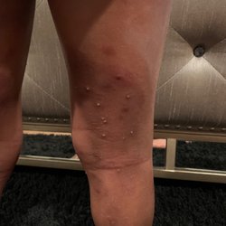 Liberty Dermatology - the reddish brown circles is where it was burning his skin.