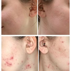 Advanced Dermatology - Thanks to Jie, my skin has never looked better! Top is today (6/2019) and bottom was before my first visit (12/2017).