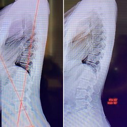 Upstate Clinic of Chiropractic - My personal x ray on lower back after 3 months. I didn't have any curve in my spine prior to being seen.