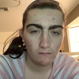 allergic reaction of the eggs allergic reaction of the eggs