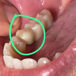 Century Medical and Dental Center - Look how much space between the crown and the gums 