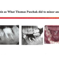 Thomas Puschak, DMD - The work flow and Procedure typically for Thomas Puschak to make patients' teeth missing
