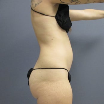 North Coast Plastic Surgery - pre op photo of abdomen - Skin Care Near Me - Oceanside, California North Coast Plastic Surgery - pre op photo of abdomen - Skin Care Near Me - Oceanside, California