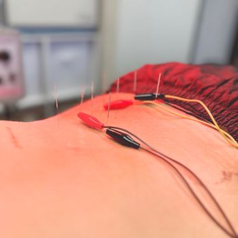 BodyMind AcuBalance - E-stim - Acupuncture Near Me - Garden Grove, California BodyMind AcuBalance - E-stim - Acupuncture Near Me - Garden Grove, California