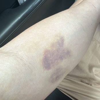 Quest Diagnostics - My arm a week after blood taken for lab test at Quest Diagnostics Fullerton - Laboratory Testing Near Me - Fullerton, California Quest Diagnostics - My arm a week after blood taken for lab test at Quest Diagnostics Fullerton - Laboratory Testing Near Me - Fullerton, California