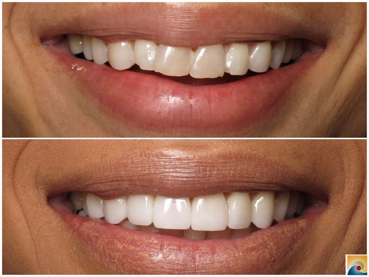 Veneers - This patient came to our office wanting a brighter, whiter smile that would make her feel confident not only in herself, but more importantly with her smile. She wanted something that would be quick, long lasting and beautiful. Now her smile matches her personality and her natural beauty. Veneers - This patient came to our office wanting a brighter, whiter smile that would make her feel confident not only in herself, but more importantly with her smile. She wanted something that would be quick, long lasting and beautiful. Now her smile matches her personality and her natural beauty.