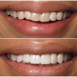 Ricardo Suarez, DDS - Straighten, whiten, and enhance any smile with Veneers