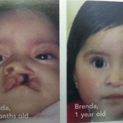 Cleft Palate Craniofacial Program - Before and after lip repair