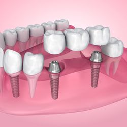 Keele Crosstown Dental - Dental Bridges in York
