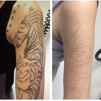 THE BEST 10 TATTOO REMOVAL in EL CAJON, CA - Updated 2025 - Hours