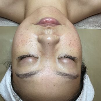 Genesys Laser Clinic - Before - Laser Hair Removal Near Me - New York, New York Genesys Laser Clinic - Before - Laser Hair Removal Near Me - New York, New York