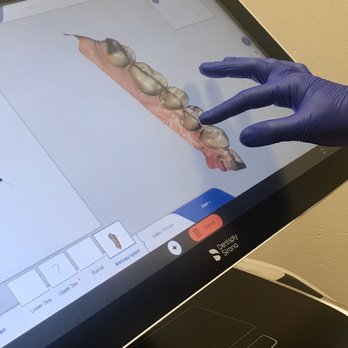 Walton Family Dentistry - 3D printer process for creating a crown - General Dentistry Near Me - Austin, Texas Walton Family Dentistry - 3D printer process for creating a crown - General Dentistry Near Me - Austin, Texas