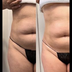 Cuerpo Aesthetics - What a difference 3 sessions can make