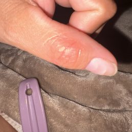 These are the bed bug bites These are the bed bug bites