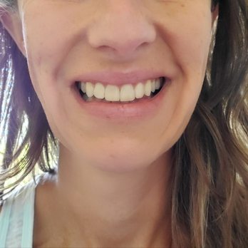 Aloha Orthodontics - Top teeth done - DONE!! - Orthodontists Near Me - Las Vegas, Nevada Aloha Orthodontics - Top teeth done - DONE!! - Orthodontists Near Me - Las Vegas, Nevada