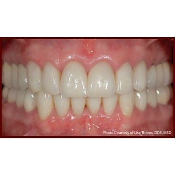 Terry L LaBell, DDS, MS, PhD - After - Periodontists Near Me - Woodinville, Washington Terry L LaBell, DDS, MS, PhD - After - Periodontists Near Me - Woodinville, Washington
