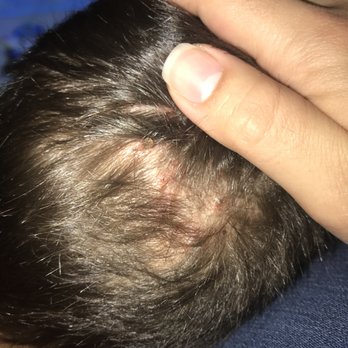 Amigo's Barber Shop - Hard to see, however his head was covered in puss filled scabs that caused him pain. - Barbers Near Me - Orlando, Florida Amigo's Barber Shop - Hard to see, however his head was covered in puss filled scabs that caused him pain. - Barbers Near Me - Orlando, Florida