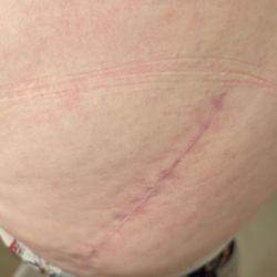 Premier Orthopaedic And Trauma Specialists - Hip Replacement Surgery. Beautifully scarring!!!