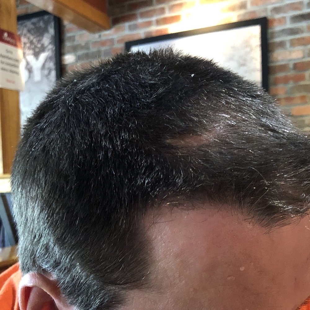 Ron's Barber Shop - Uneven on the sides, too short on the top, surgical scar visible. - Barbers Near Me - Boiling Springs, North Carolina Ron's Barber Shop - Uneven on the sides, too short on the top, surgical scar visible. - Barbers Near Me - Boiling Springs, North Carolina