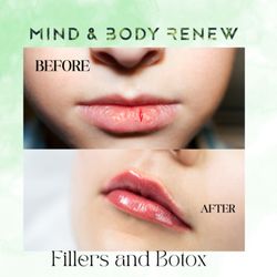 Mind & Body Renew - Lip filler