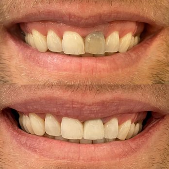 SmileOn Dentistry - Porcelain crown placement to restore function and aesthetics - Cosmetic Dentists Near Me - Marina del Rey, California SmileOn Dentistry - Porcelain crown placement to restore function and aesthetics - Cosmetic Dentists Near Me - Marina del Rey, California