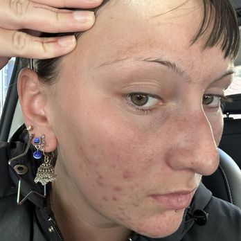 Acne Treatment SF - Before - Skin Care Near Me - San Francisco, California Acne Treatment SF - Before - Skin Care Near Me - San Francisco, California