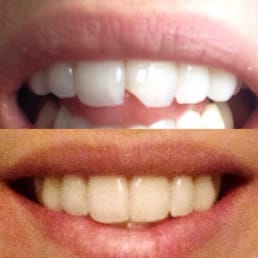 Chipped tooth fixed by Dr. Lopez. Chipped tooth fixed by Dr. Lopez.