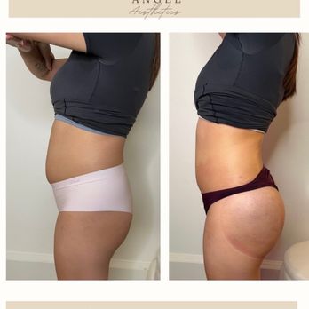 Angel Aesthetics - Body Contouring Near Me - Sacramento, California Angel Aesthetics - Body Contouring Near Me - Sacramento, California