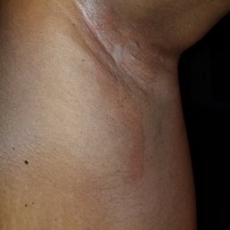 The left underarm that also tore