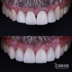 Arapahoe Dental - "Before and after replacing anterior veneers to restore natural proportions, color, and smile harmony in Boulder, CO."