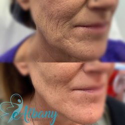 Albany Cosmetic & Laser Centre - Non-surgical facelift with Threads