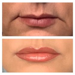 Ideal Image Nashville - Lips, marionette lines, & nasolabial. Amazing transformation! I love them!  I'm SO SO happy!