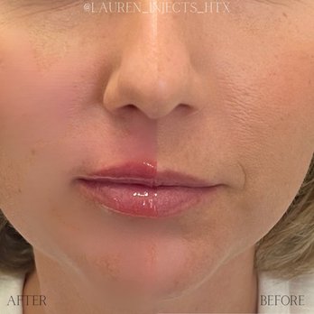 NIMS Medspa - Small lip filler - Skin Care Near Me - Houston, Texas NIMS Medspa - Small lip filler - Skin Care Near Me - Houston, Texas