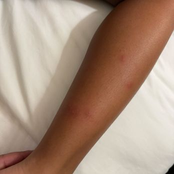 World Motel - Bed bugs - Hotels Near Me - Lynwood, California World Motel - Bed bugs - Hotels Near Me - Lynwood, California