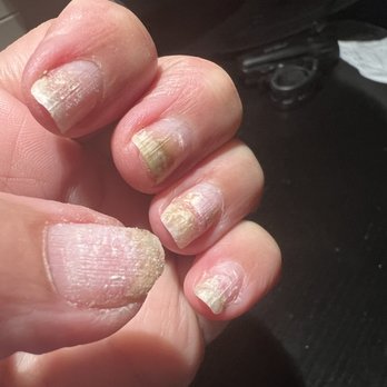 Diamond Nails - Fungus Infection - Nail Salons Near Me - Naples, Florida Diamond Nails - Fungus Infection - Nail Salons Near Me - Naples, Florida