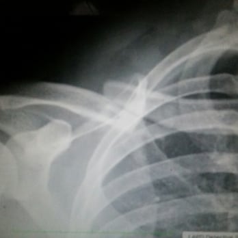 Coastal Ortho - Broken Clavicle!!! - Sports Medicine Near Me - Torrance, California