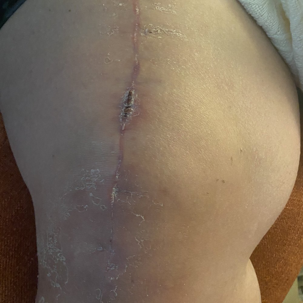 One month out and the scar is healing great. Ignore the dry skin, he needs to lotion up One month out and the scar is healing great. Ignore the dry skin, he needs to lotion up